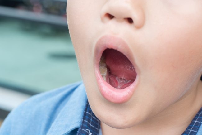 Orofacial Myofunctional Therapy